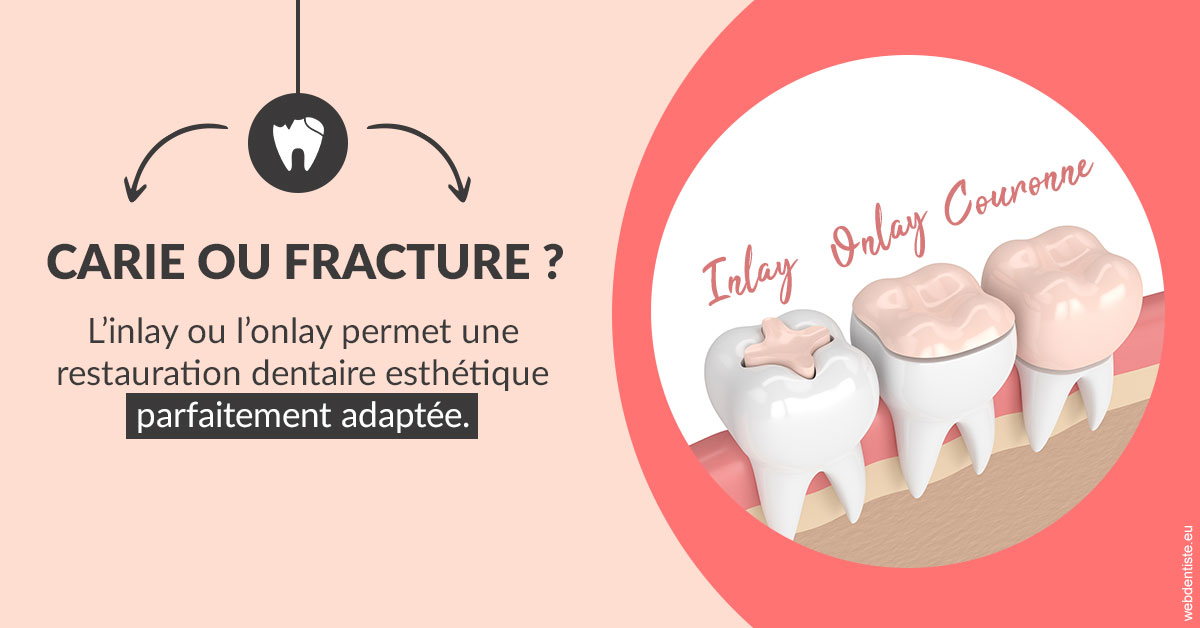https://dr-marcais-yvick.chirurgiens-dentistes.fr/T2 2023 - Carie ou fracture 2