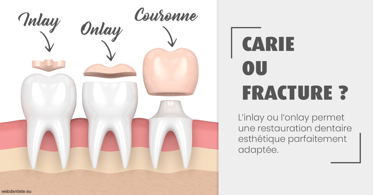 https://dr-marcais-yvick.chirurgiens-dentistes.fr/T2 2023 - Carie ou fracture 1