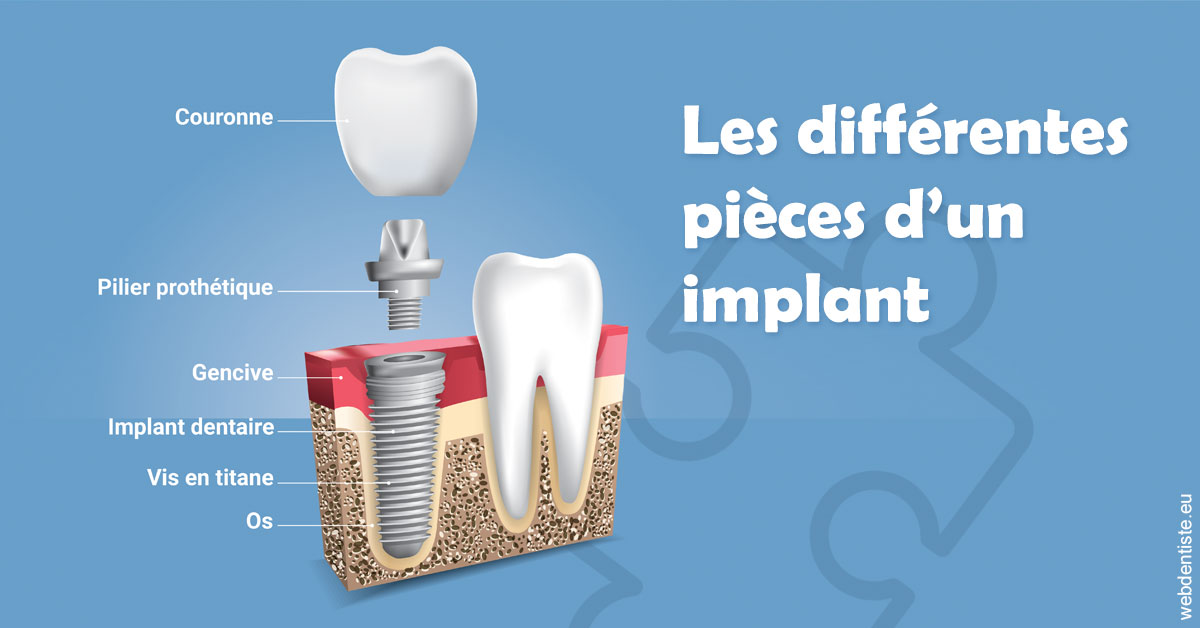 https://dr-marcais-yvick.chirurgiens-dentistes.fr/Les différentes pièces d’un implant 1